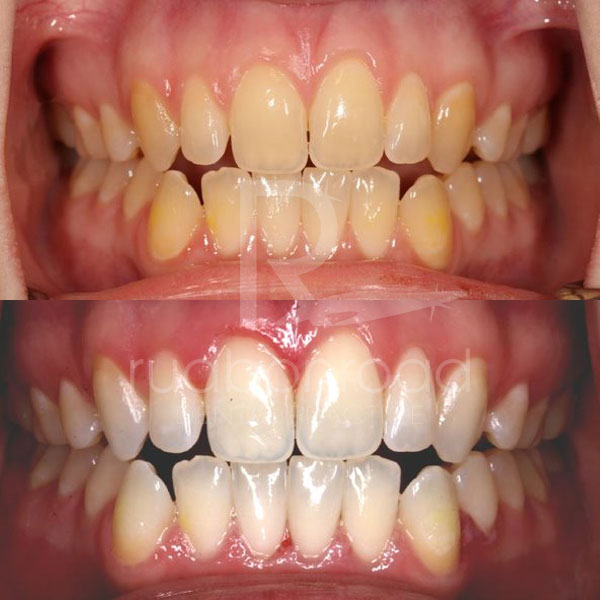 Teeth whitening before and after photo