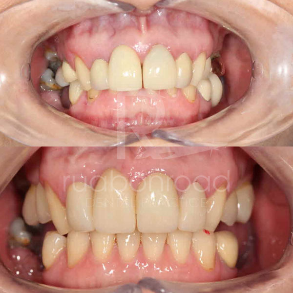 Teeth surgery and crowns before and after photo