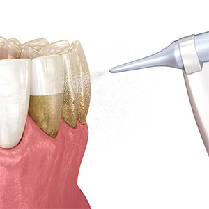 Diagram showing Airflow treatment