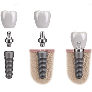 Illiustration of how dental implants are fitted
