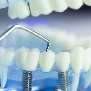 Dental implant model