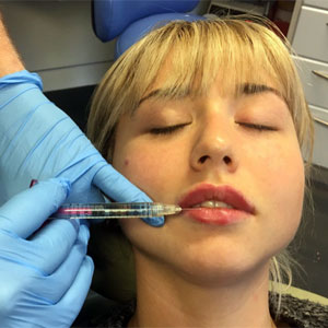 Lady having dermal filler injection in Wrexham