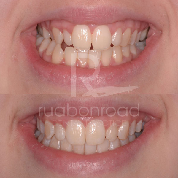 Invisalign® to correct cross-bite and crowding