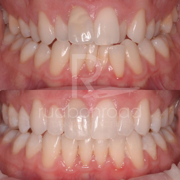 Invisalign® to close gaps in teeth and improve the balance of the patient’s smile