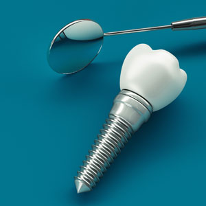 Dental implant