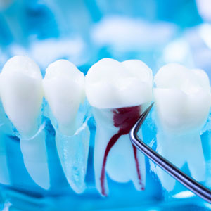 Endodontic treated tooth