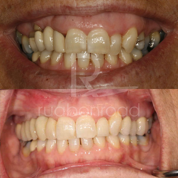 Dental implants before and after photo