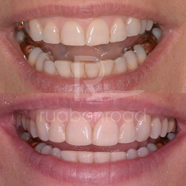 Recountoured teeth before and after photo