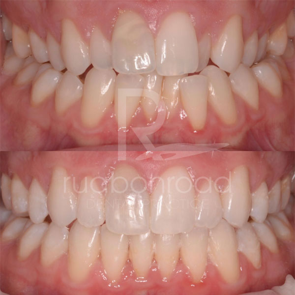 Orthodontic treatments before and after photo