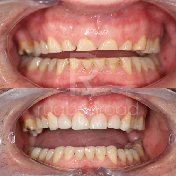 Composite fillings before and after photo
