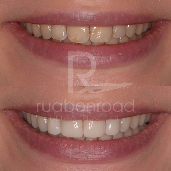Porcelain veneers before and after photo