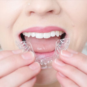 Lady holding Smilelign aligner