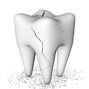 Illustration of cracked tooth