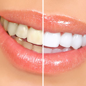 Woman showing results of teeth whitening