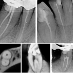 Capturing Endodontic Excellence